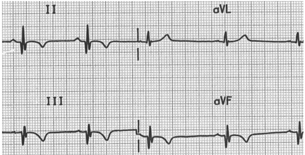 Sóng Q sâu (II, III, aVF) với đảo ngược sóng T do MI trước đây