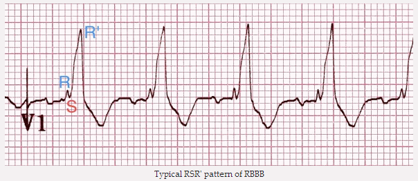 Hình RSR' điển hình của RBBB