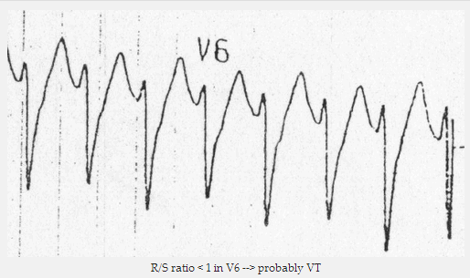 Tỷ lệ R / S < 1 trong V6 => có lẽ VT