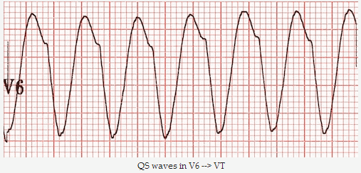 Sóng QS trong V6 => VT