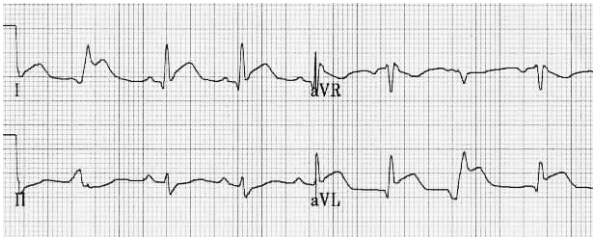 Sóng Q thành bên (I, aVL) với ST chênh lên do MI cấp.