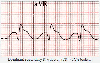 Ưu thế cuối sóng R' trong aVR => độc tính TCA