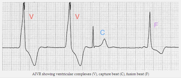 AIVR thấy phức thất (V), bắt nhịp (C), kết hợp nhịp (F)