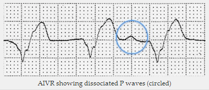 AIVR cho thấy các sóng P phân ly (vòng tròn)