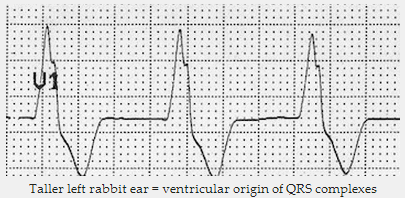 Tai thỏ bên trái cao hơn = nguồn gốc tâm thất của phức bộ QRS