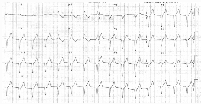 Phức bộ QRS rộng 90 bpm