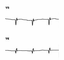 Sóng Q thành bên (V5-6) với sóng T phẳng do MI trước đây.