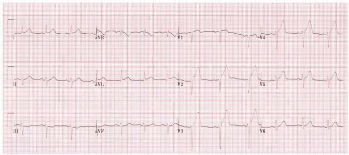 STEMI trước vách câp