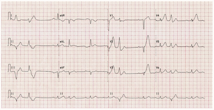 STEMI trước vách câp