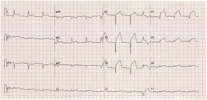 STEMI vùng trước tiến triển