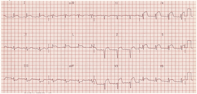 STEMI trước bên lan rộng