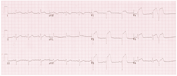 STEMI vùng trước lan rộng