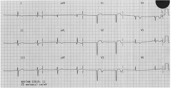 Trước khi MI trước vách