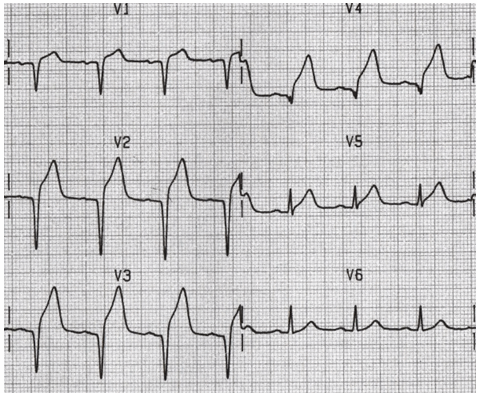 Sóng Q vùng trước (V1 - 4) với ST chênh lên do MI cấp.