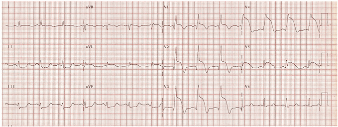 STEMI trước vách, khả năng tắc gần LAD