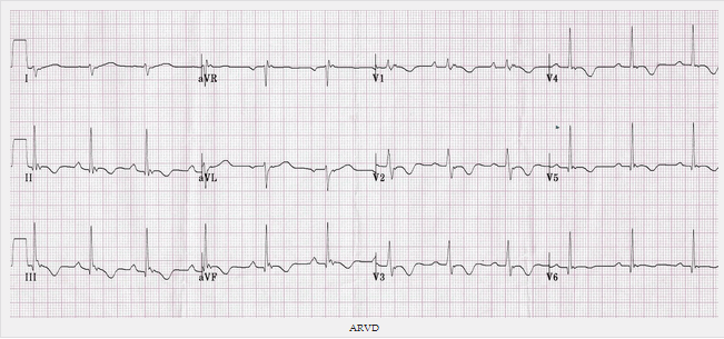 Loạn sản thất phải Arrhythmogenic (AVRD)