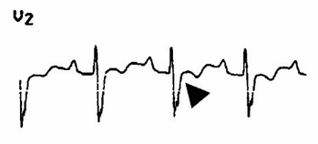 Xem xét thêm các ví dụ của sóng Epsilon