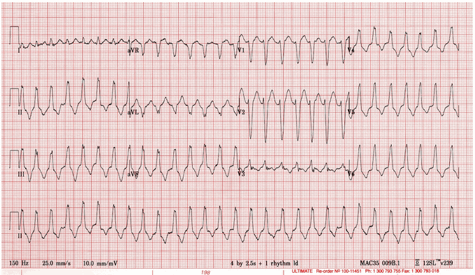 VT thất phải với hình thái LBBB