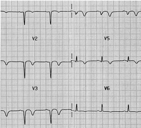 ECG bình thường ở trẻ em (2 tuổi)