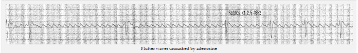 Sóng rung được chỉ ra bởi adenosine