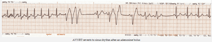 AVNRT trở về với nhịp xoang sau một liều bolus adenosine 