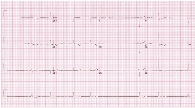 AF với đáp ứng thất chậm