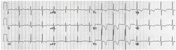 Phì đại tâm thất phải (RVH) 