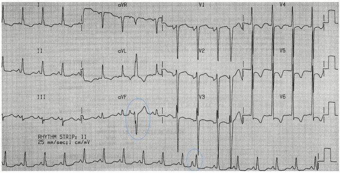 PACs bình thường và dẫn truyền dị thường