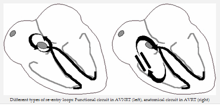 Các loại khác nhau của các vòng vào lại: vòng vào lại chức năng trong AVNRT (trái), vào lại trong AVRT (bên phải)