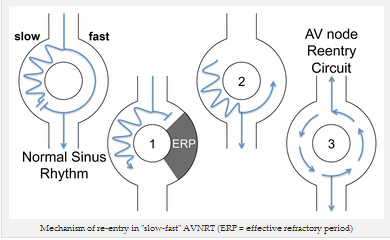 Cơ chế vào lại trong "chậm-nhanh" AVNRT