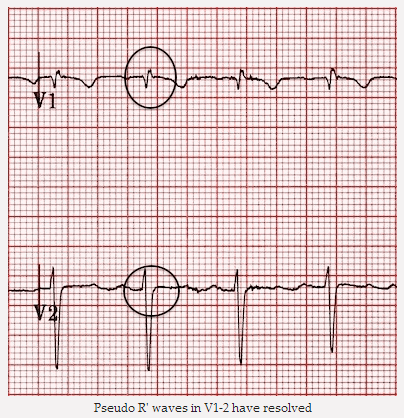 Sóng giả R' trong V1 - 2 đã được giải quyết