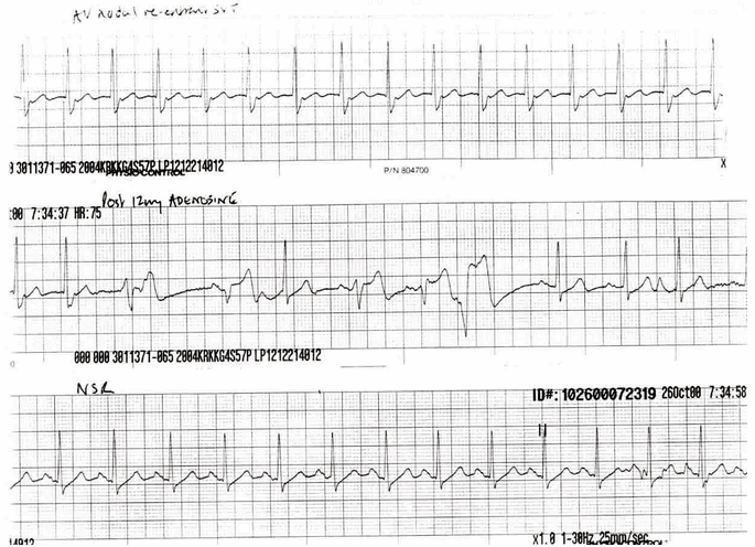 Bệnh nhân AVNRT chậm - nhanh điều trị với adenosine