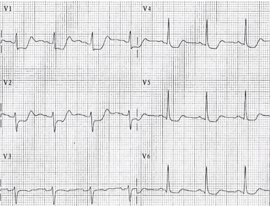 Điện tâm đồ nhoif máu cơ tim thành sau (MI sau)