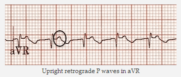 Sóng P thẳng ngược dòng trong aVR