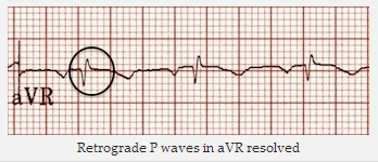 Sóng P ngược trong aVR đã được giải quyết