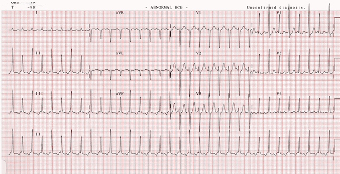 SVT với QRS so le