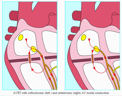 AVRT với dẫn truyền nút AV orthodromic (trái) và antidromic (phải)