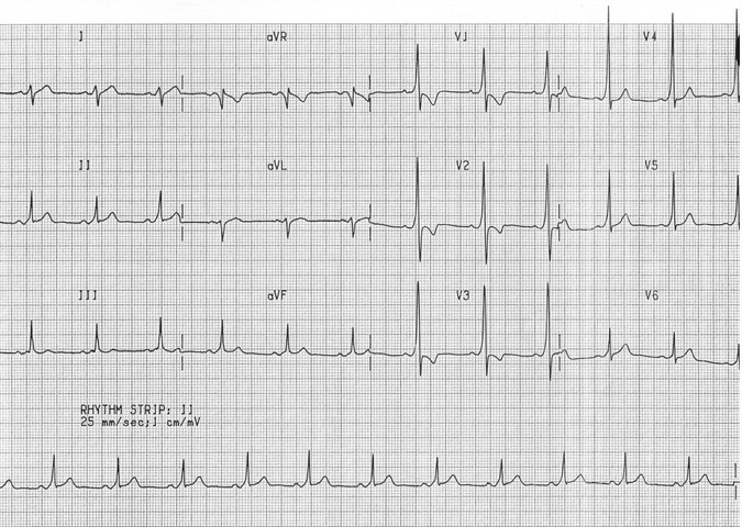 WPW với sóng R chiếm ưu thế trong đạo trình V1 và trước tim phải