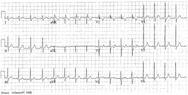 QRS rộng và sóng delta nhẹ được thể hiện rõ hơn trong những đứa trẻ lớn tuổi