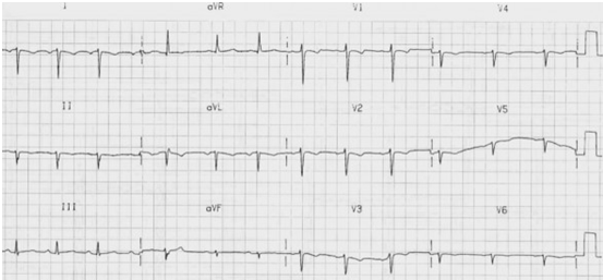 Dextrocardia