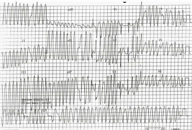  AF với WPW, nhịp tim nhanh bất thường phức bộ rộng rất nhanh