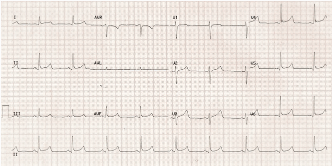 Độ cao ST và điểm J nổi bật hơn ở một nhịp tim chậm.