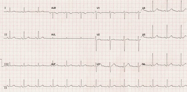 Độ cao ST và điểm J trở nên ít nổi bật khi tăng nhịp tim. 