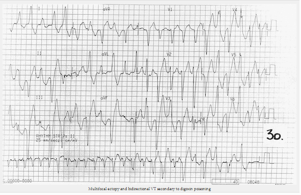 Đa ổ lạc chỗ và VT hai chiều do ngộ độc digoxin