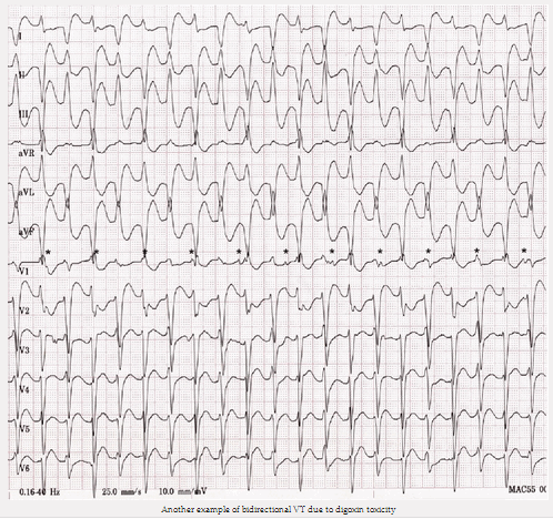 VT hai chiều do độc tính digoxin