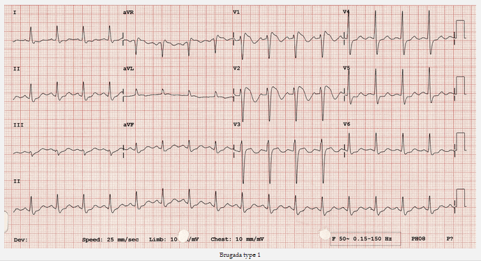 Brugada type 1