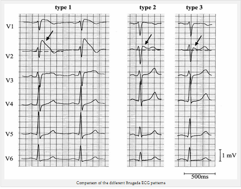 So sánh các hình điện tâm đồ Brugada khác nhau