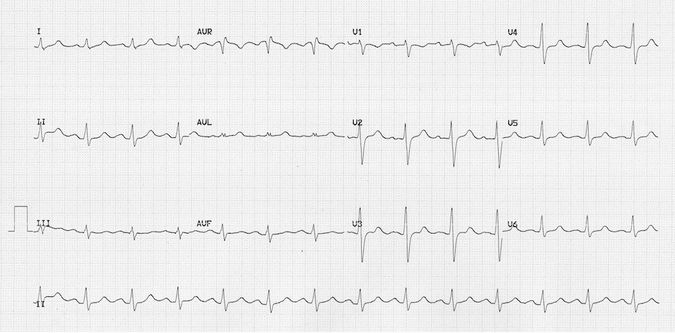 ECG đầu tiên đã được thực hiện vài giờ sau khi dùng carbamazepine quá liều