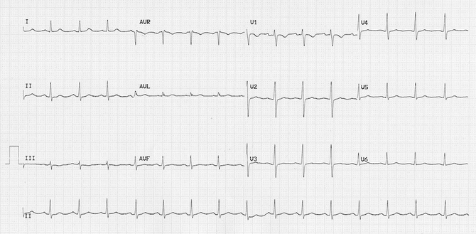 ECG thứ hai được chụp vài giờ sau khi đặt nội khí quản