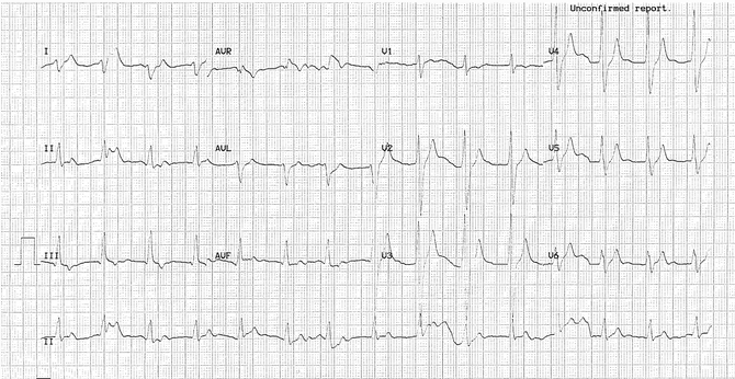 sau quá liều carbamazepine lớn